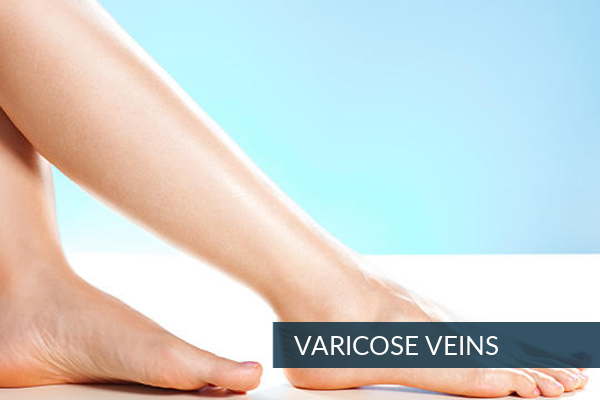 Varicose Veins Treatment